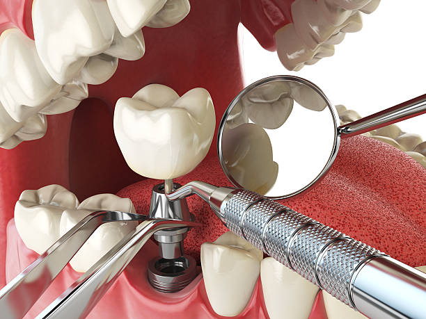Best Emergency Dentist for Knocked-Out Tooth in Charleston, MO